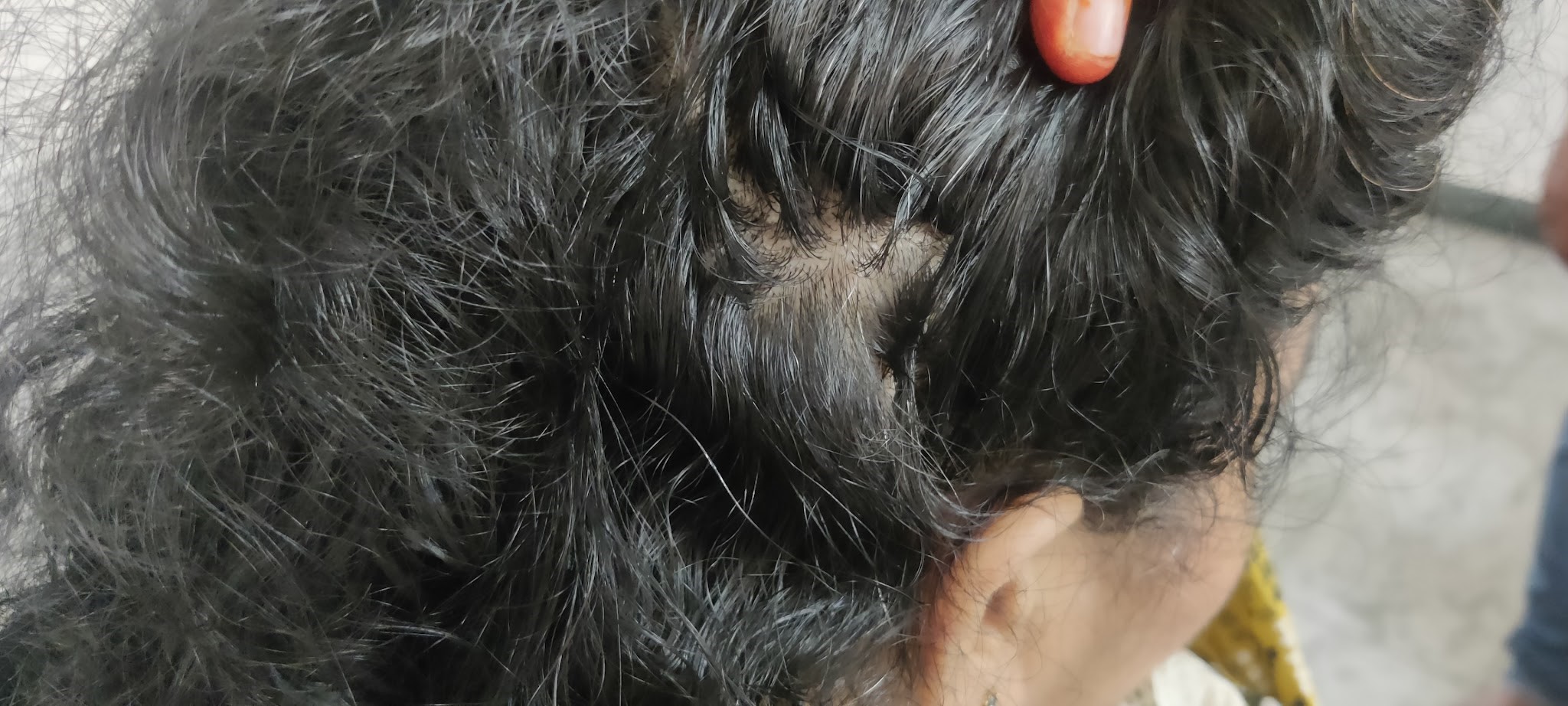 Alopecia Areata treatment